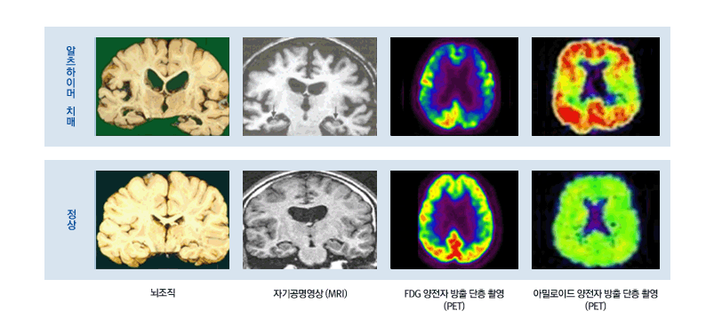 알츠하이머, 정상 뇌구조를 비교하는 이미지 [뇌조직, 자기공명영상(MRI), FDG 양전자 방출 단층 촬영(PET), 아밀로이드 양전자 방출 단층 촬영(PET)]