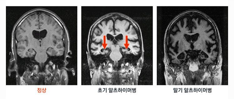 [그림 - 경과에 따른 알츠하이머병 MRI 사진] 정상, 초기 알츠하이머병, 말기 알츠하이머 병