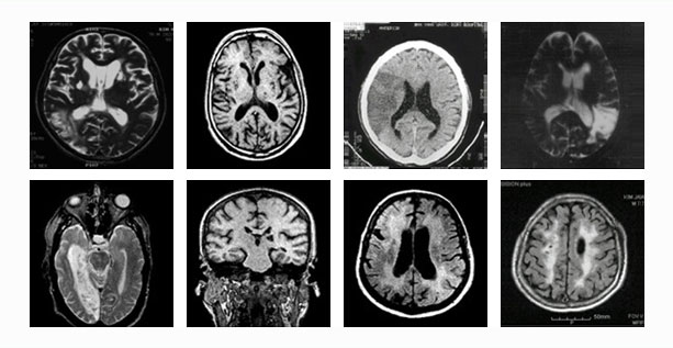 [그림 - 혈관성 치매 MRI 사진] 혈관성 치매 뇌구조에 대한 8종류의 이미지