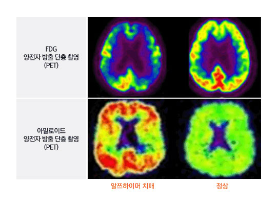 [그림 - 기능적 뇌영상 검사] FDG 양전자 방출 단층 촬영(PET), 알밀로이드 양전자 방출 단층 촬영(PET) 알쯔하이머 치매, 정상 뇌구조 이미지